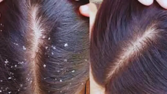 Dandruff